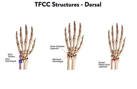 Ulnar Wrist Pain Causes