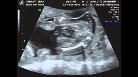 What Does My Baby Look Like At 18 Weeks Ultrasound - Baby Viewer