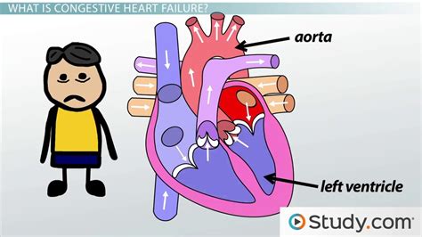 Congestive Heart Failure Cartoon