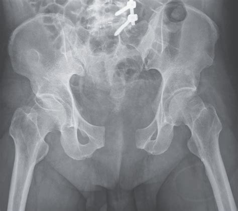 Pelvic Fracture X Ray