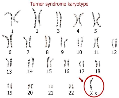 Sindrome De Turner Cromossomos - SOLOLEARN