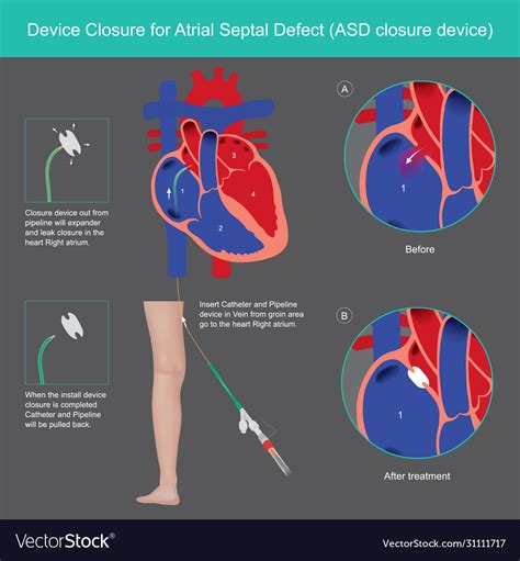 Device closure for atrial septal defect explain Vector Image