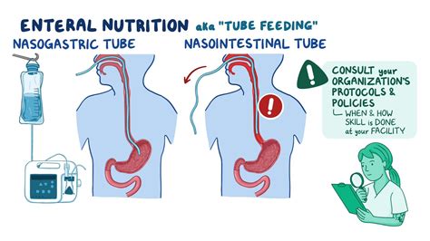 Nutrition - Enteral: Nursing skills - Osmosis Video Library