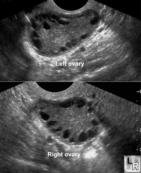 Womens Health: normal ovary ultrasound