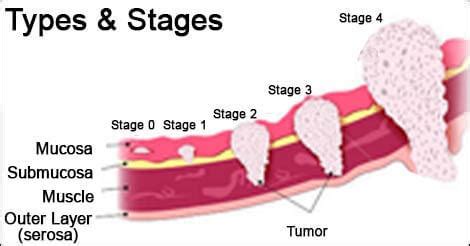 Stomach Cancer Types | Stages of Stomach Cancer