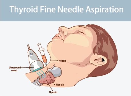 Work Your Way Through Thyroid FNA Reports With NCCI Advice