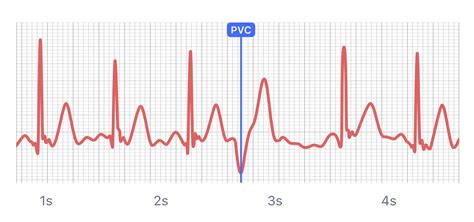 Frontiers Smartwatch Electrocardiograms For Automated And, 46% OFF