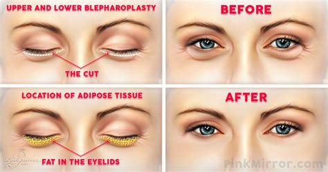 How To Minimise The Appearance Of Under Eye Bags: Surgery To Get Rid Of ...