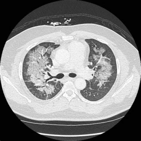 Pulmonary Alveolar Proteinosis – Differential Diagnosis of Crazy Paving ...