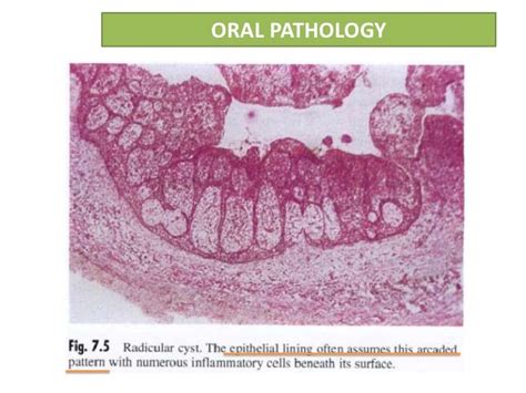 Radicular cyst or Periapical cyst