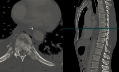 Thoracolumbar Burst Fractures - Spine - Orthobullets