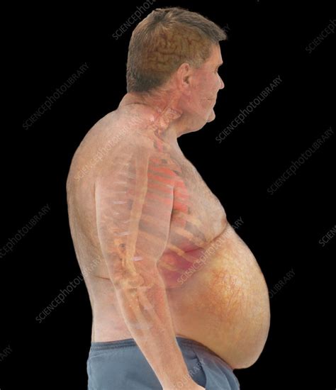 Visceral Fat - Stock Image - C043/6158 - Science Photo Library