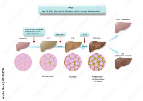 Various stages of fatty liver disease (NAFLD) Stock Illustration ...