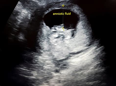 Amniotic Fluid Is Sterile in Uncomplicated Term Pregnancies ...