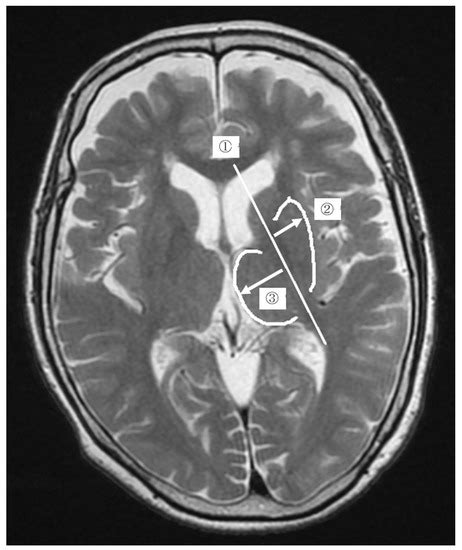 Putamen Atrophy Is a Possible Clinical Evaluation Index for Parkinson’s Disease Using Human ...