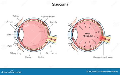 Glaucoma High Pressure Effect on Optic Nerve Stock Vector ...