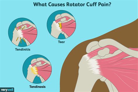 Rotator Cuff Pain: Overview and More