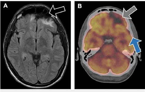 A. MRI brain scan revealing encephalomalacia of both inferior frontal ...