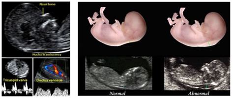 Pin on prenatal screening