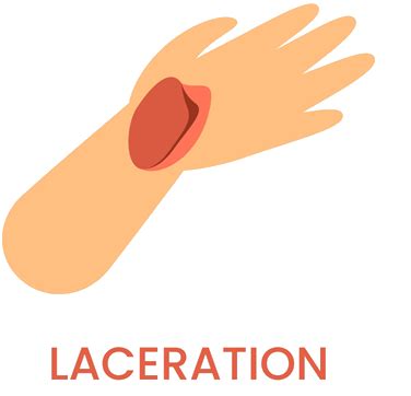 Learn about Lacerations | MCR Safety Info Blog