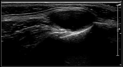 Neck Lipoma Ultrasound Images - Infoupdate.org