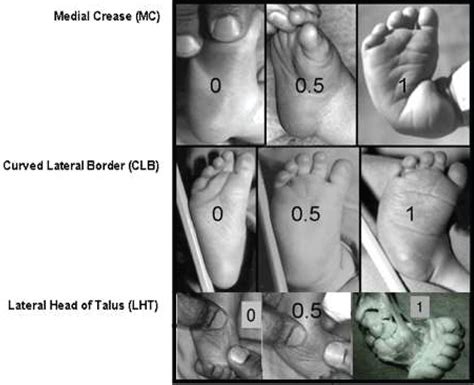 Figure From Congenital Talipes Equinovarus: A Staged Method, 55% OFF