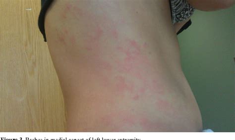 Figure 3 from Lamotrigine overdose cause skin rash and angioedema | Semantic Scholar