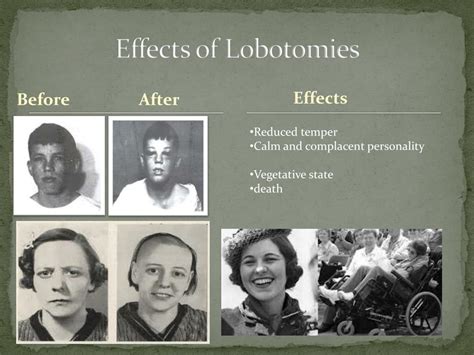 PPT - Lobotomies PowerPoint Presentation, free download - ID:2332936