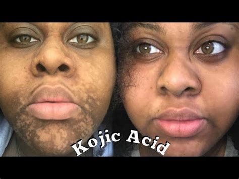 Kojic Acid Soap Before After