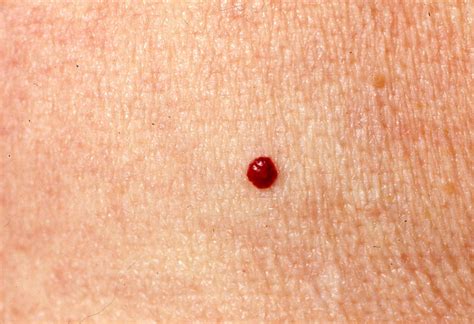 Cherry Angioma: Definition, Causes & Home Remedies - Home Remedies