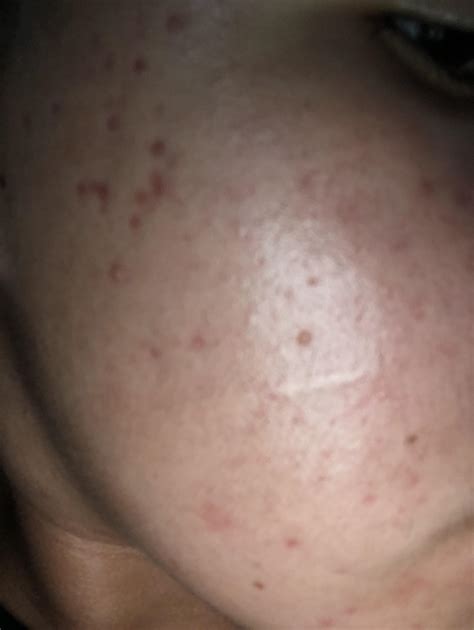 Red Dots On Face : Skin Bumps That Look Like Pimples But Aren T - What is that for / what does ...