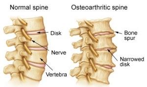 Bone Spurs and Osteophytes - AKSIS Special Hospital