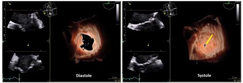 Three-dimensional (3D) echocardiography of the tricuspid valve with ...