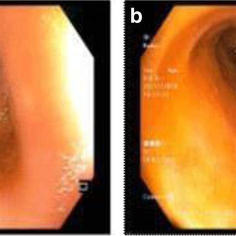 a, b Normal terminal ileum on colonoscopy | Download Scientific Diagram