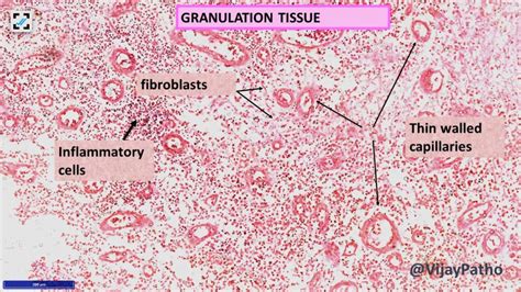 TISSUE REPAIR: By Connective tissue deposition. Angiogenesis & Tissue ...