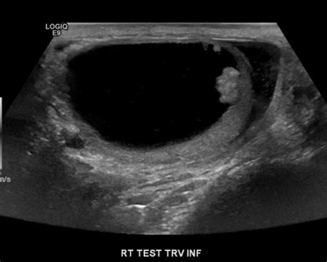 A 58-Year-Old Man Presenting With a Cystic Neoplasm of the Testis - Renal and Urology News