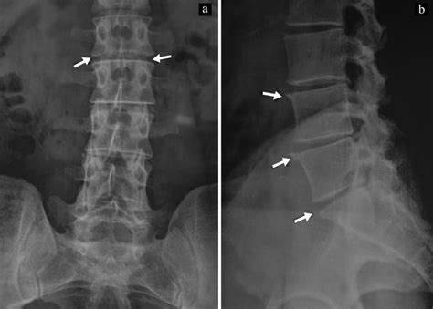 Alkaptonuria presenting as ochronotic spondylo-arthropathy in siblings with low back pain: a ...