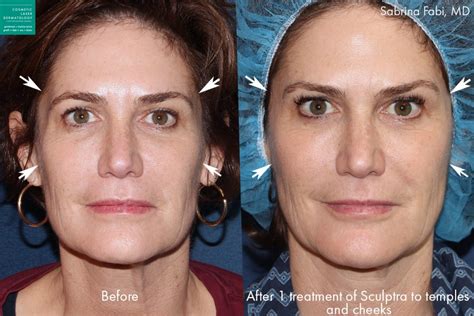 Sculptra Injectable Medical Spa | San Diego, CA | CLDerm