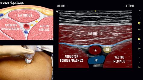 Ultrasound Guided Saphenous Subsartorius Adductor Canal Nerve Block ...