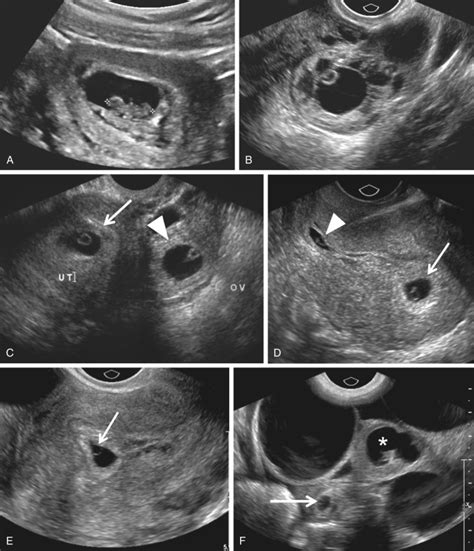 Ectopic Pregnancy | Radiology Key