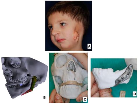 JCM | Free Full-Text | Use of a Fibula Free Flap for Mandibular Reconstruction in Severe ...