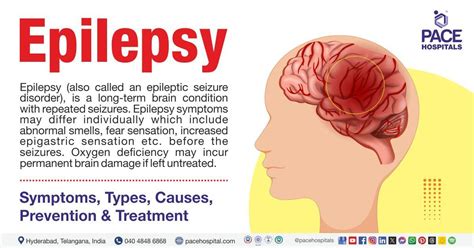 Epilepsy Symptoms Causes Treatment – NBKomputer