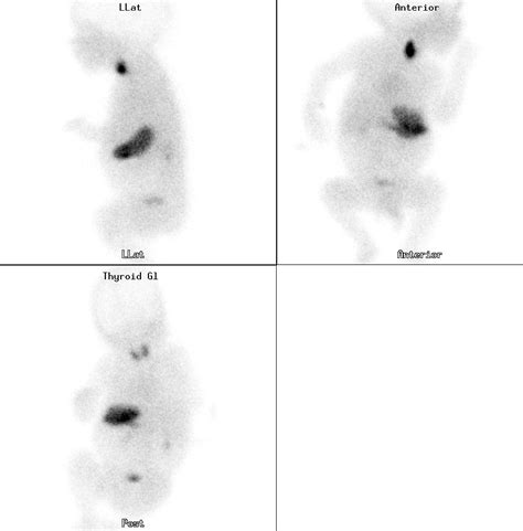 Nuclear Medicine & PET: Thyroid scintigraphy: Paediatric