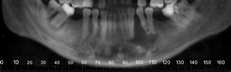 Case of the Week: Odontogenic Myxoma – Dr. G's Toothpix