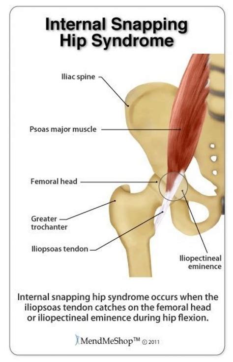 Internal snapping hip syndrome occurs when the iliopsoas tendon catches on the femoral head or ...