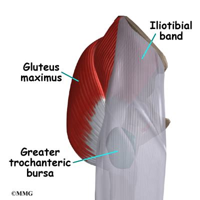 Trochanteric Bursitis Surgery - eOrthopod.com