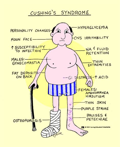 ALL FOR NURSING: MS: Addison's Disease vs Cushing's Disease