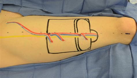 Markings of the ALT flap including glansplasty are made in black. The... | Download Scientific ...