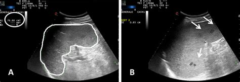 Case 3: Ultrasound. a Splenomegaly: splenic area 76 cmq; b... | Download Scientific Diagram