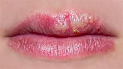 Cold Sore And Swelling Lips | Sitelip.org